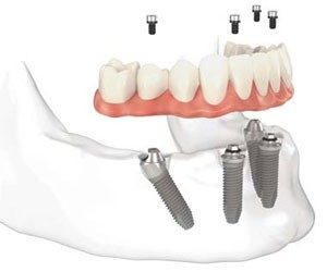 Как протича зъбното възстановяване с базални импланти?